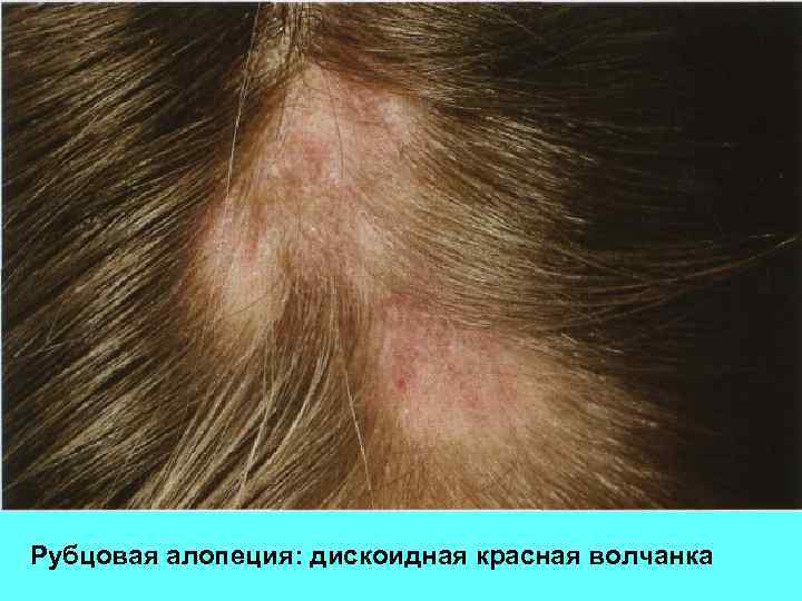 Рубцовая алопеция: дискоидная красная волчанка 