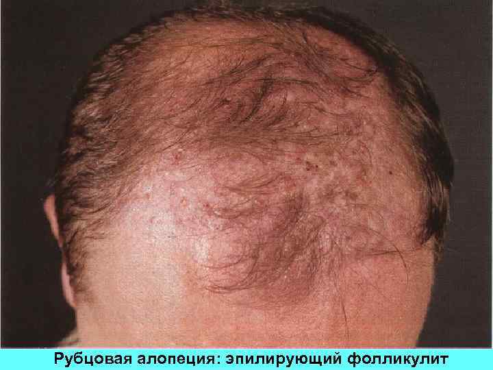 Рубцовая алопеция: эпилирующий фолликулит 