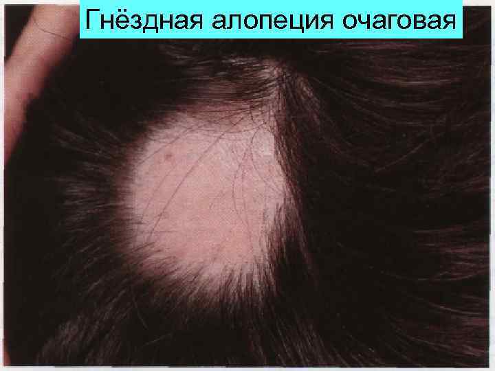Гнёздная алопеция очаговая 