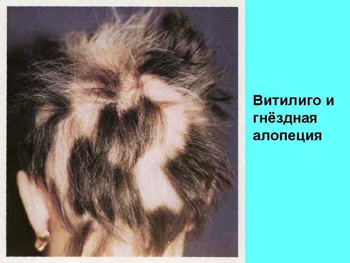 Витилиго и гнёздная алопеция 