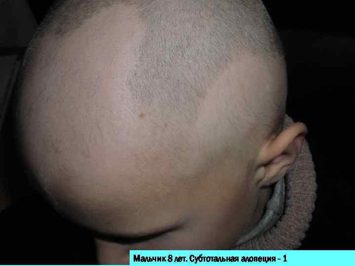 Мальчик 8 лет. Субтотальная алопеция - 1 