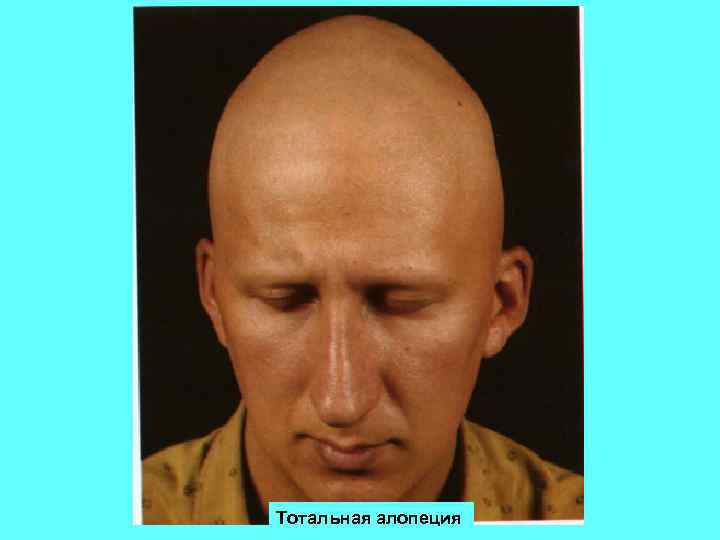 Тотальная алопеция 
