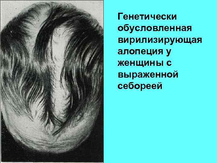Генетически обусловленная вирилизирующая алопеция у женщины с выраженной себореей 