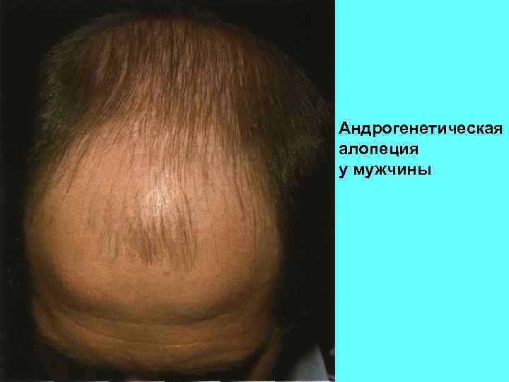 Андрогенетическая алопеция у мужчины 