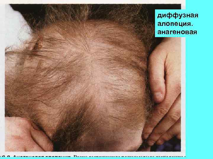 диффузная алопеция. анагеновая 