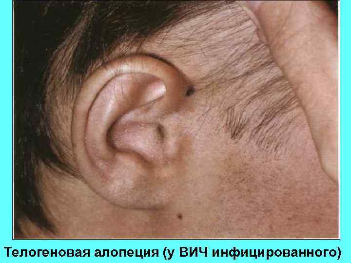 Телогеновая алопеция (у ВИЧ инфицированного) 