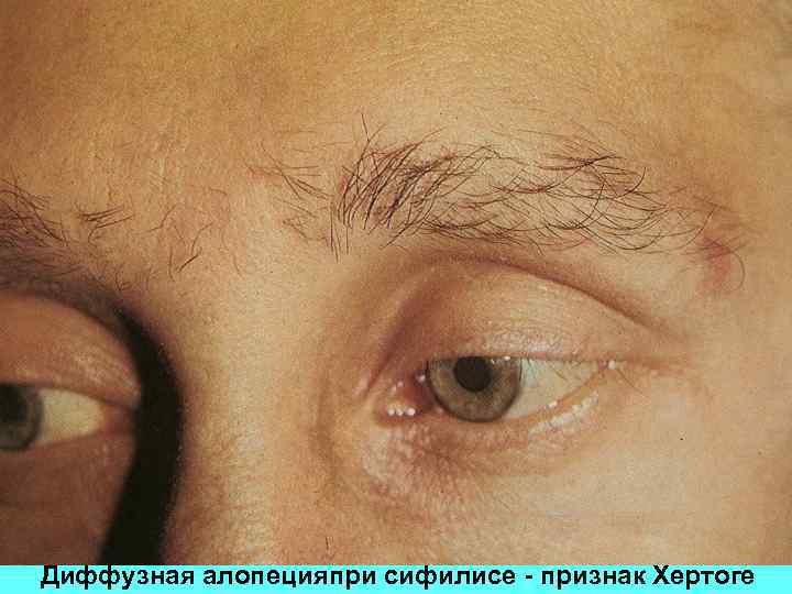 Диффузная алопецияпри сифилисе - признак Хертоге 