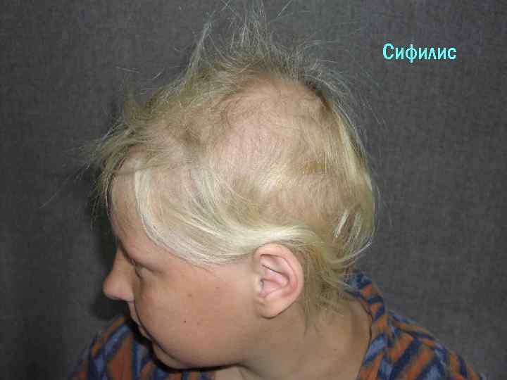 Сифилис 