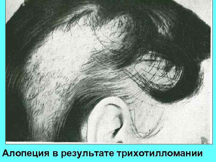 Алопеция в результате трихотилломании 