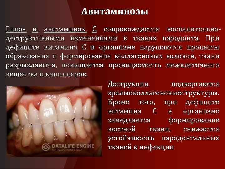 Авитаминозы Гипо и авитаминоз С сопровождается воспалительно деструктивными изменениями в тканях пародонта. При дефиците
