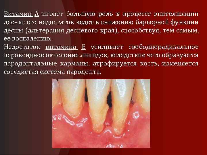 Витамин А играет большую роль в процессе эпителизации десны; его недостаток ведет к снижению