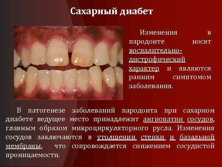 Сахарный диабет Изменения в пародонте носят воспалительно дистрофический характер и являются ранним симптомом заболевания.