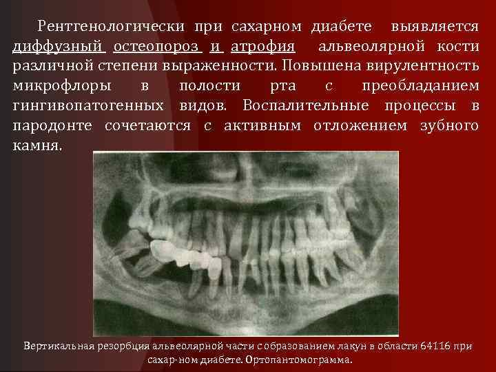 Рентгенологически при сахарном диабете выявляется диффузный остеопороз и атрофия альвеолярной кости различной степени выраженности.