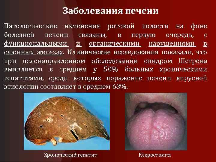 Заболевания печени Патологические изменения ротовой полости на фоне болезней печени связаны, в первую очередь,