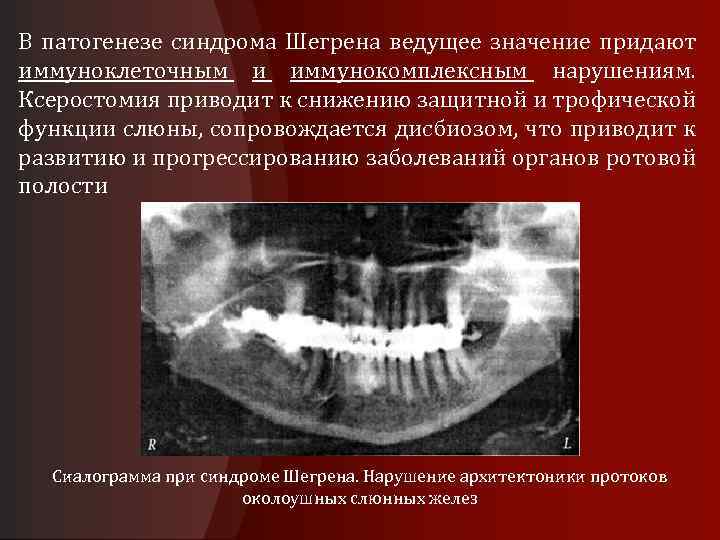 В патогенезе синдрома Шегрена ведущее значение придают иммуноклеточным и иммунокомплексным нарушениям. Ксеростомия приводит к