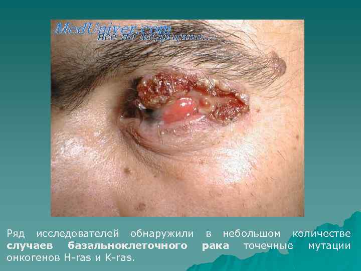 Ряд исследователей обнаружили в небольшом количестве случаев базальноклеточного рака точечные мутации онкогенов H-ras и