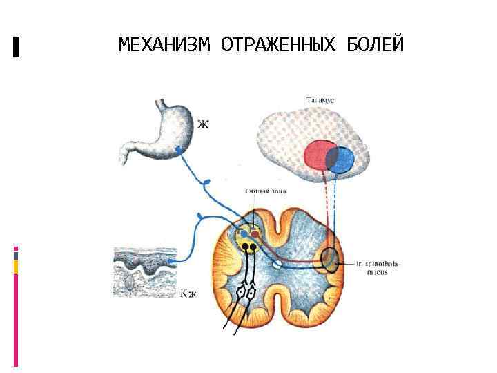 МЕХАНИЗМ ОТРАЖЕННЫХ БОЛЕЙ 