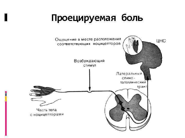 Проецируемая боль 