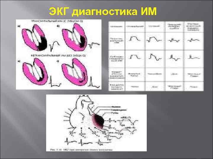 ЭКГ диагностика ИМ 