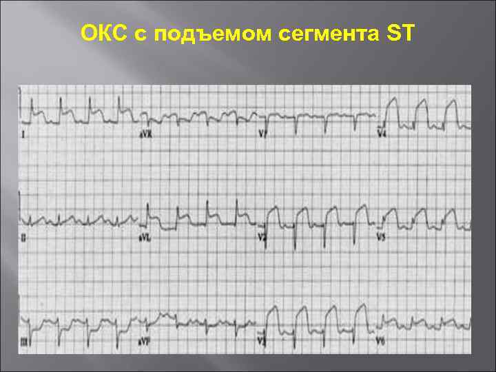 Карта вызова при окс с подъемом st