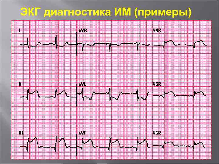 ЭКГ диагностика ИМ (примеры) 