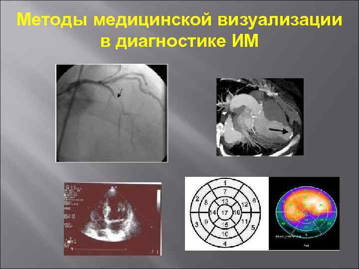 Методы медицинской визуализации в диагностике ИМ 