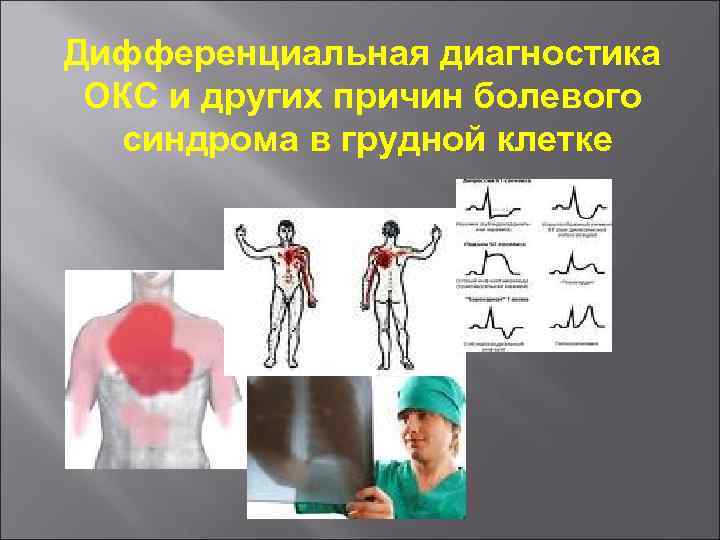 Дифференциальная диагностика ОКС и других причин болевого синдрома в грудной клетке 