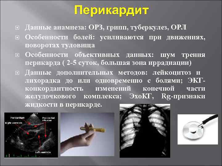 Перикардит Данные анамнеза: ОРЗ, грипп, туберкулез, ОРЛ Особенности болей: усиливаются при движениях, поворотах туловища