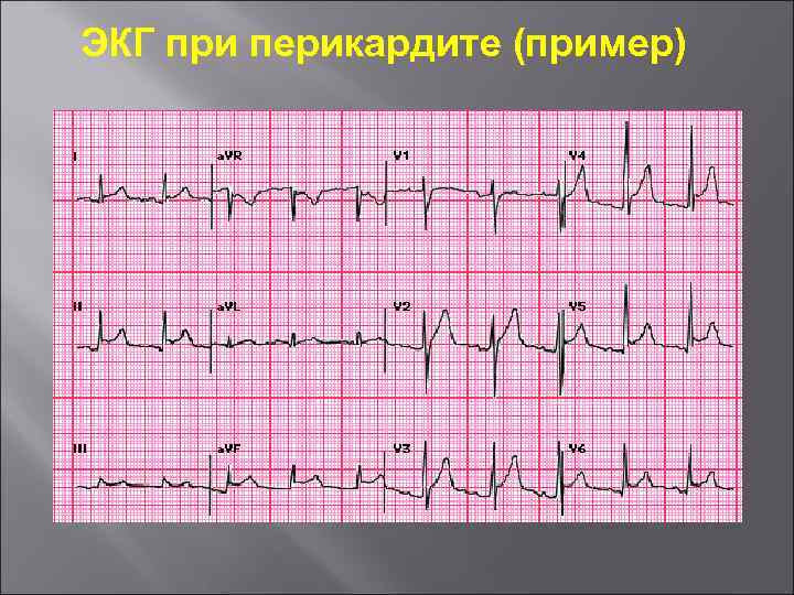 ЭКГ при перикардите (пример) 