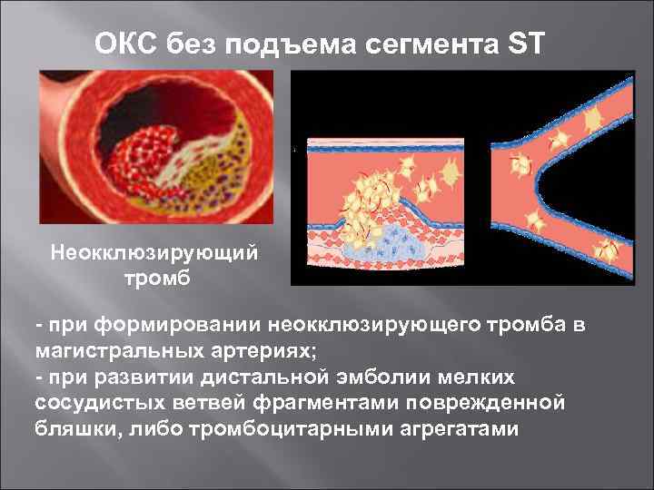 Окклюзирующий тромбоз. Острый коронарный синдром без подъема сегмента St. Неокклюзирующий тромбоз что это. ИБС без подъема St. Окс без подъема St.