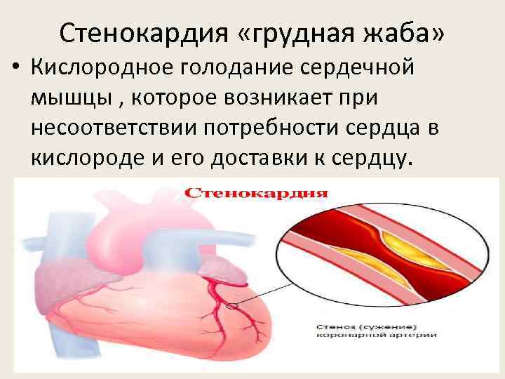 Стенокардия «грудная жаба» • Кислородное голодание сердечной мышцы , которое возникает при несоответствии потребности