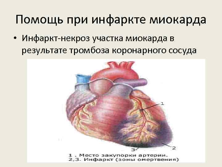 Помощь при инфаркте миокарда • Инфаркт-некроз участка миокарда в результате тромбоза коронарного сосуда 