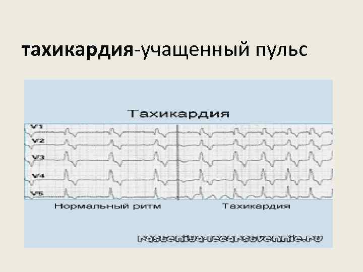 тахикардия-учащенный пульс 