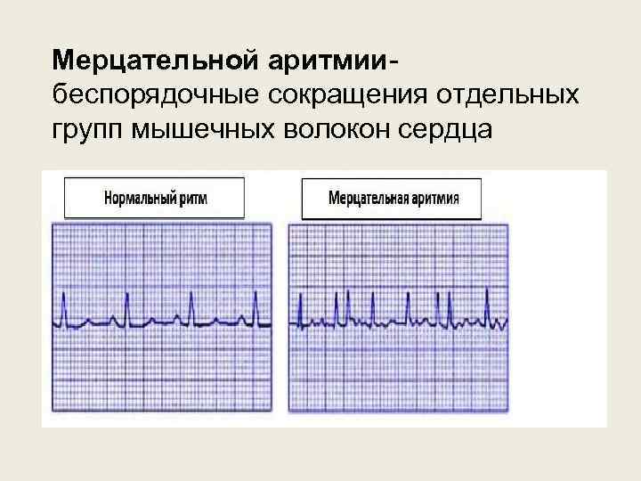 Мерцательной аритмиибеспорядочные сокращения отдельных групп мышечных волокон сердца 