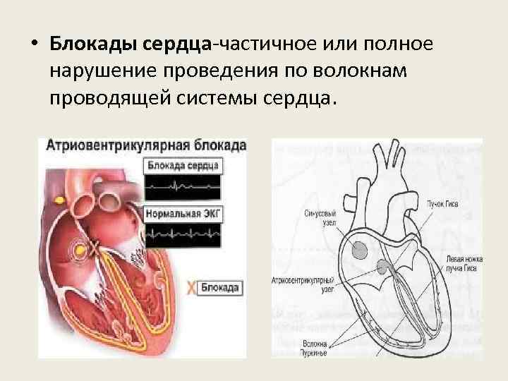  • Блокады сердца-частичное или полное нарушение проведения по волокнам проводящей системы сердца. 