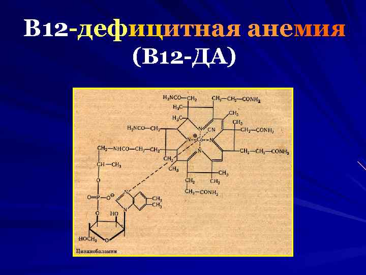 В 12 -дефицитная анемия (В 12 -ДА) 