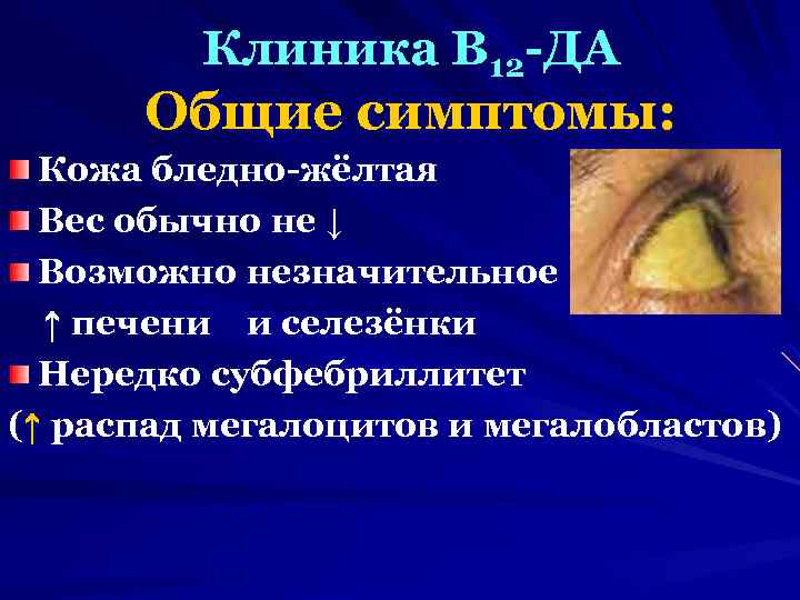 Клиника В 12 -ДА Общие симптомы: Кожа бледно-жёлтая Вес обычно не ↓ Возможно незначительное