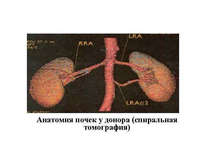 Анатомия почек у донора (спиральная томография) 