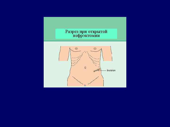 Разрез при открытой нефрэктомии 