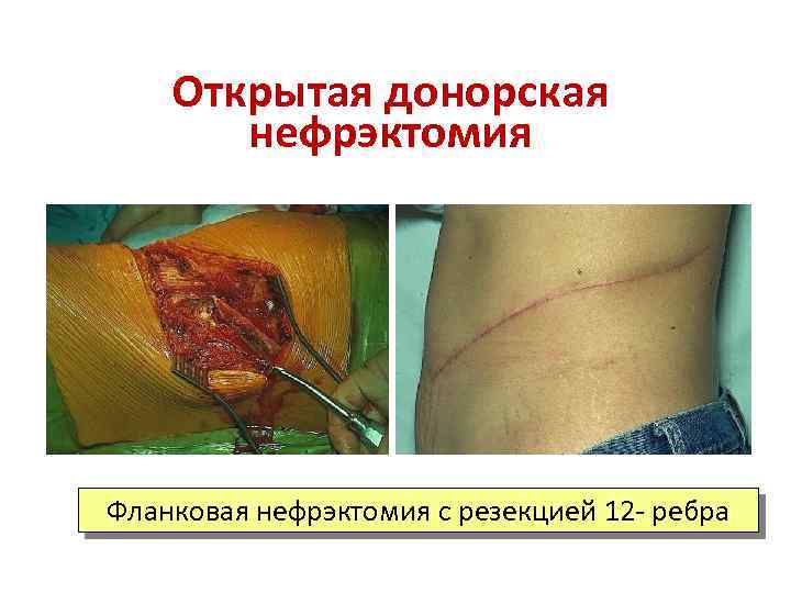 Открытая донорская нефрэктомия Фланковая нефрэктомия с резекцией 12 - ребра 