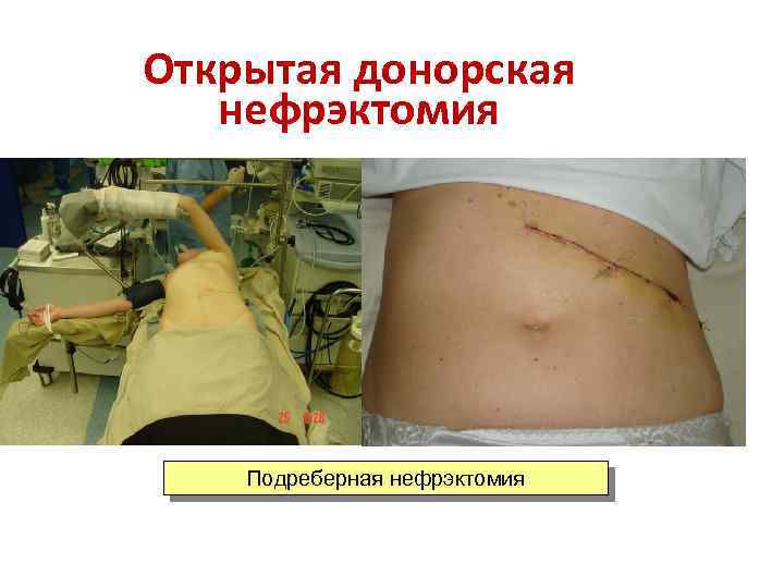 Открытая донорская нефрэктомия Подреберная нефрэктомия 