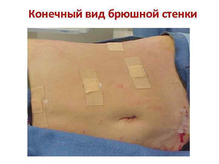 Конечный вид брюшной стенки 