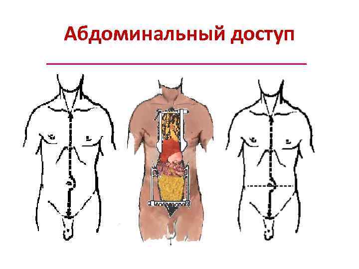 Абдоминальный доступ 