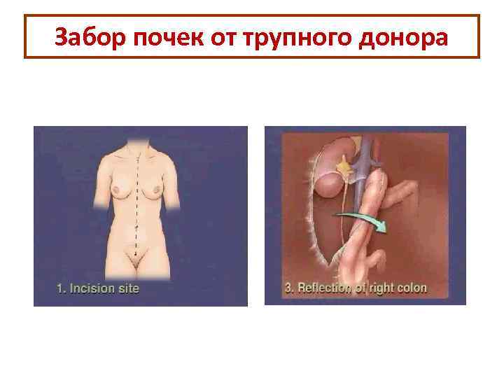 Забор почек от трупного донора 