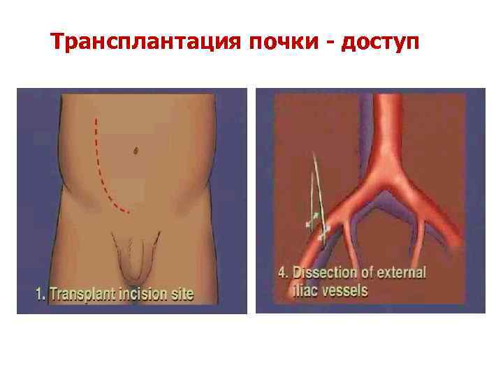 Трансплантация почки - доступ 