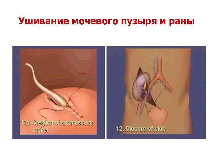 Ушивание мочевого пузыря и раны 