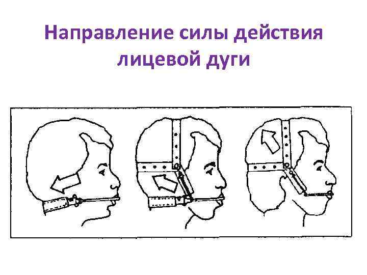 Направление силы действия лицевой дуги 