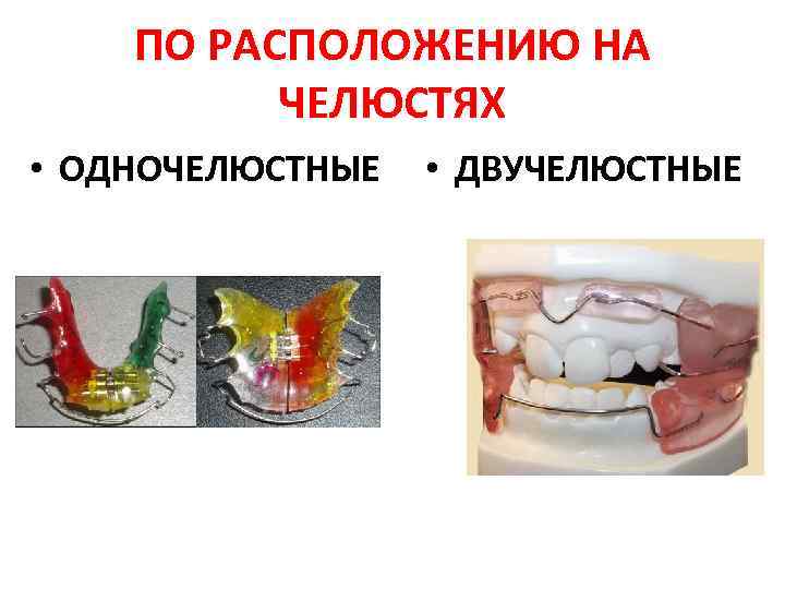 Внеротовые ортодонтические аппараты презентация