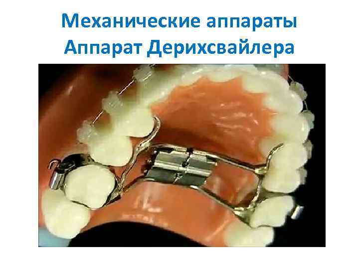 Механические аппараты Аппарат Дерихсвайлера 