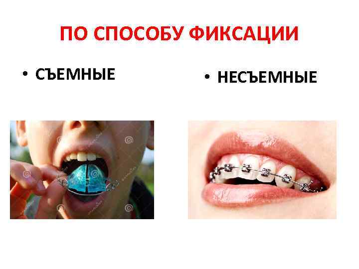 ПО СПОСОБУ ФИКСАЦИИ • СЪЕМНЫЕ • НЕСЪЕМНЫЕ 